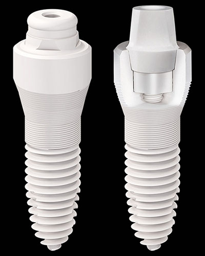 SDS Keramikimplantat (Beispiel)